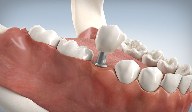 Zahn­implantate