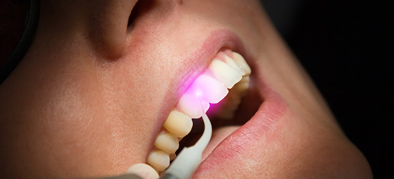 Laserbehandlung