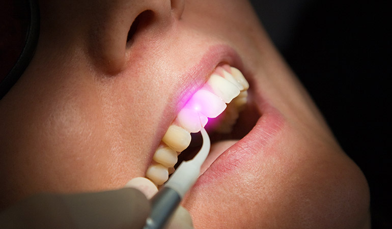 Laserbehandlung